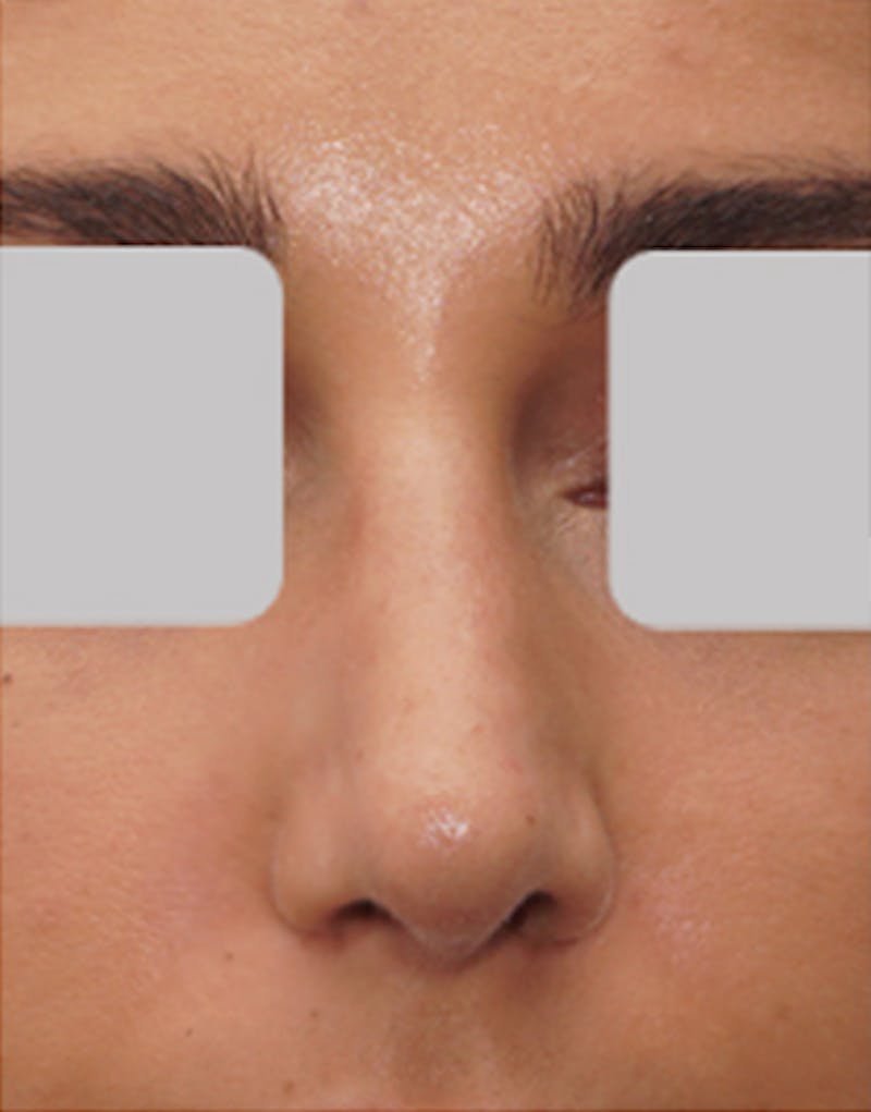 Rhinoplasty  Before & After Gallery - Patient 182505 - Image 4