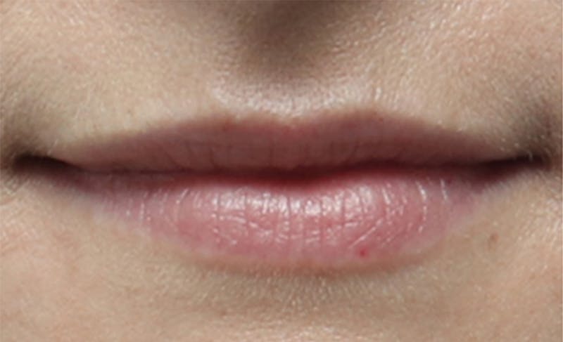 Lip Fillers Before & After Gallery - Patient 156246 - Image 1