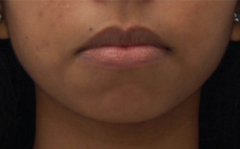 Chin Surgery Before & After Gallery - Patient 193401 - Image 3