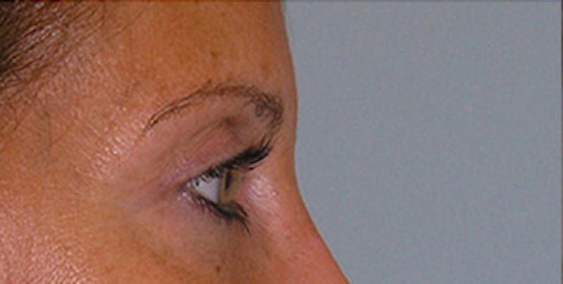 Eyelid Surgery Before & After Gallery - Patient 197125 - Image 8
