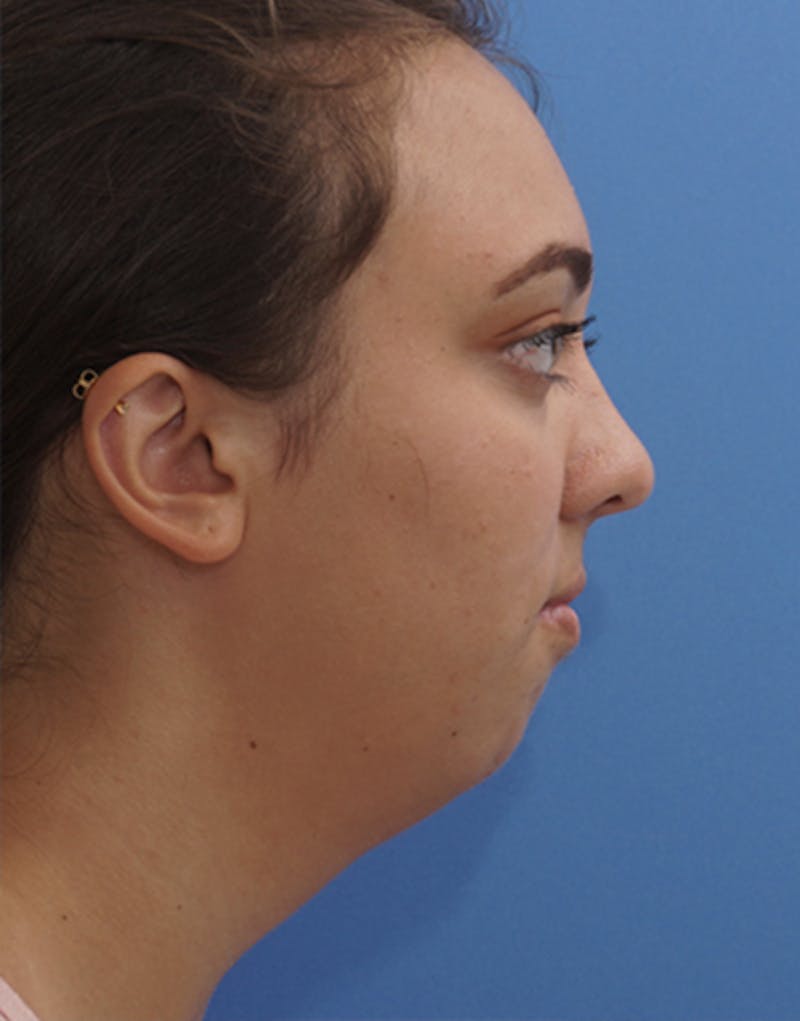 FaceTite Before & After Gallery - Patient 118273 - Image 3