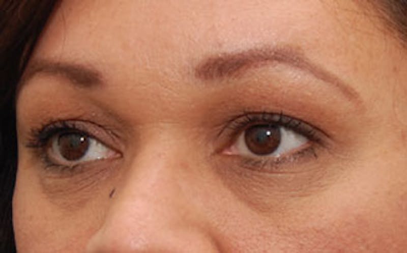 Fillers Before & After Gallery - Patient 341310 - Image 3