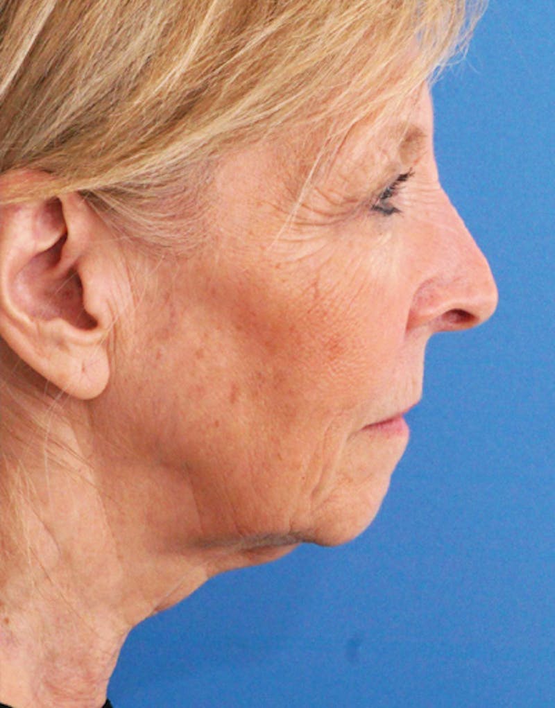 Facelift Before & After Gallery - Patient 112261 - Image 5