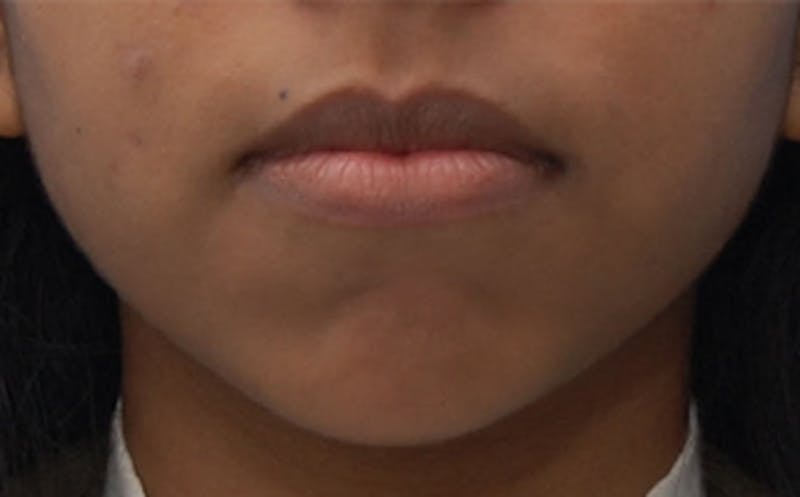 Chin Surgery Before & After Gallery - Patient 193401 - Image 4