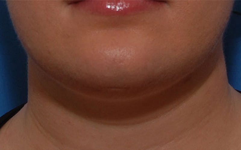 Kybella Before & After Gallery - Patient 690409 - Image 1