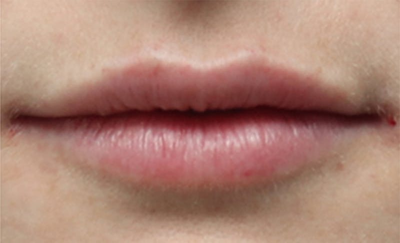 Lip Fillers Before & After Gallery - Patient 156246 - Image 2