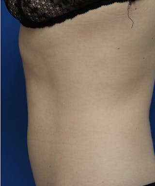 Fractora / Morpheus Before & After Gallery - Patient 137370 - Image 4