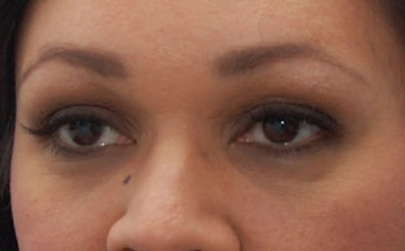 Fillers Before & After Gallery - Patient 341310 - Image 4