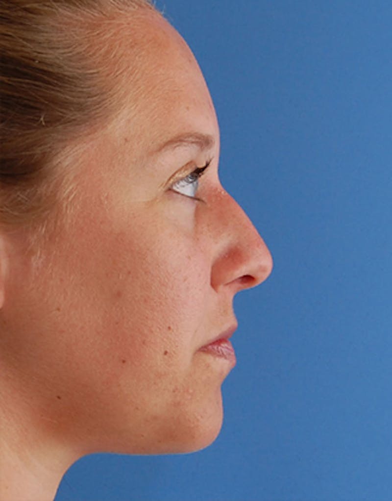 Patient X1rjkLqNSH6vUbDeoaOzwA - Rhinoplasty Before & After Photos