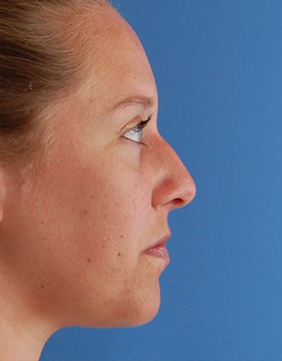 Rhinoplasty Before & After Gallery - Patient 145106 - Image 1
