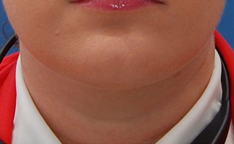 Kybella Before & After Gallery - Patient 690409 - Image 2
