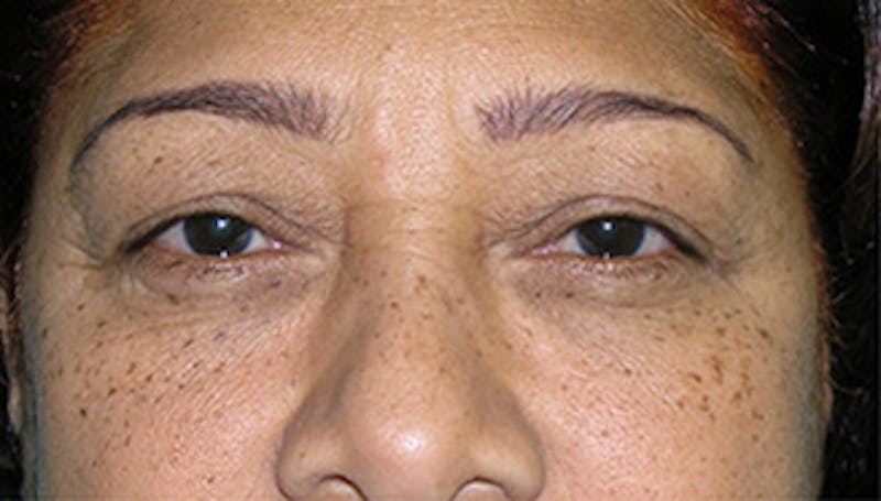 Patient LY2vSSPPRjSt5bYCv9MXJw - Eyelid Surgery Before & After Photos