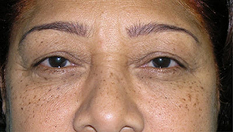 Eyelid Surgery Before & After Gallery - Patient 424184 - Image 1