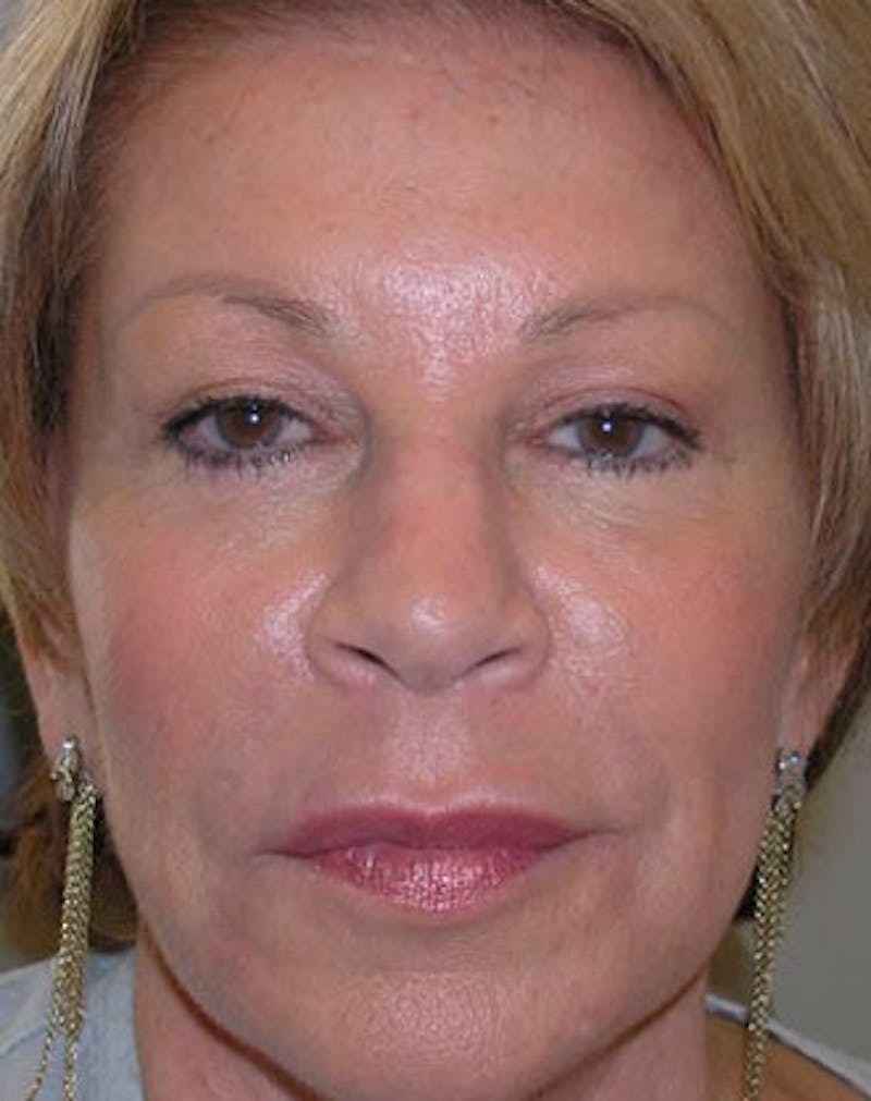 BOTOX Before & After Gallery - Patient 239068 - Image 2