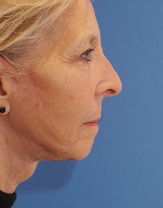 Facelift Before & After Gallery - Patient 112261 - Image 6