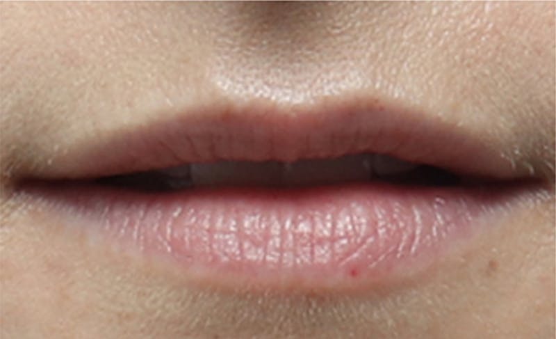 Lip Fillers Before & After Gallery - Patient 156246 - Image 3