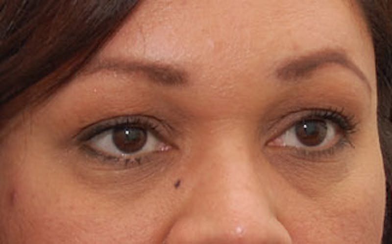 Fillers Before & After Gallery - Patient 341310 - Image 5
