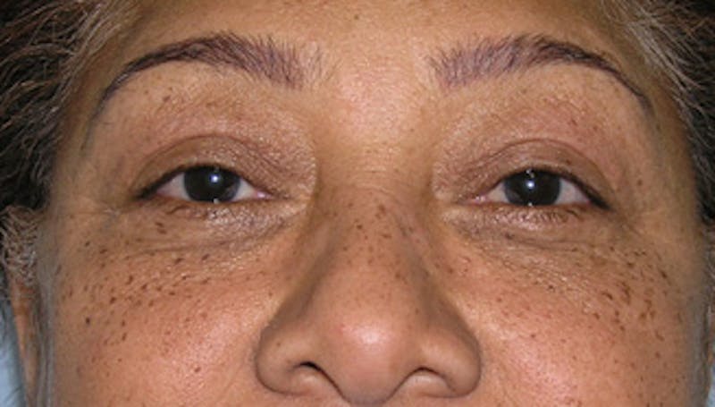 Eyelid Surgery Before & After Gallery - Patient 424184 - Image 2