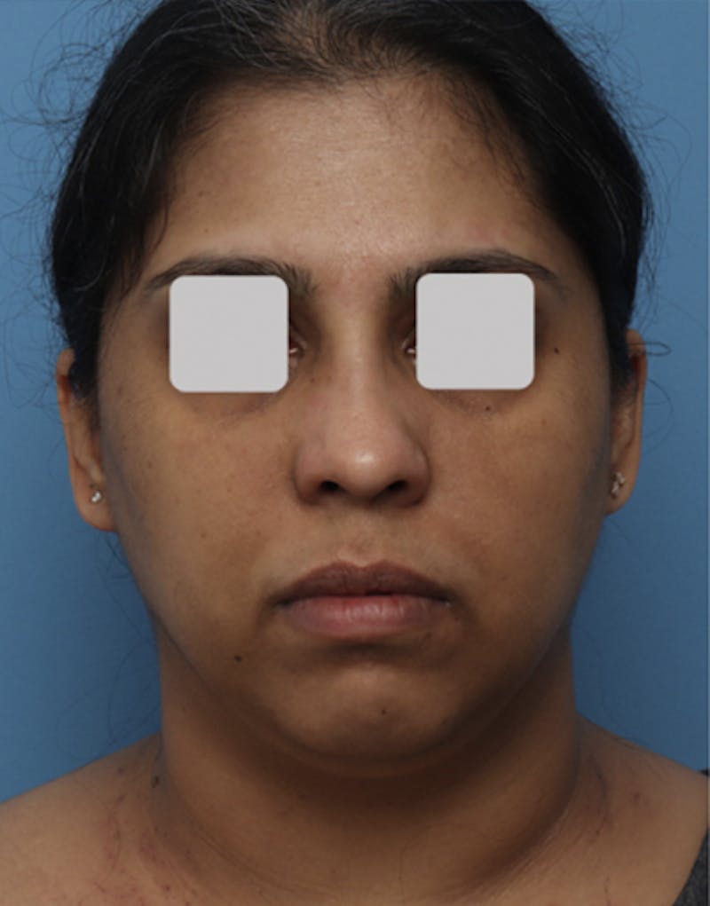 FaceTite Before & After Gallery - Patient 149793 - Image 1
