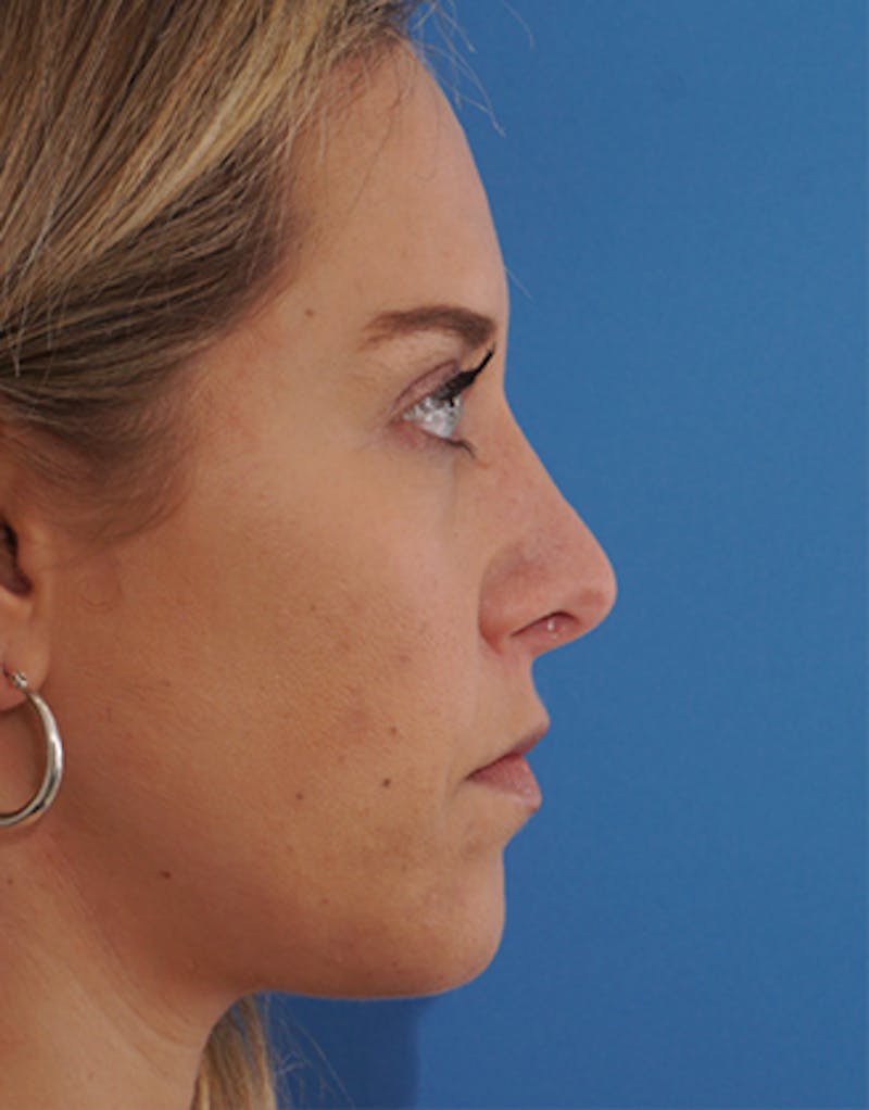 Rhinoplasty Before & After Gallery - Patient 388796 - Image 2