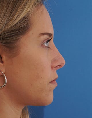 Rhinoplasty Before & After Gallery - Patient 145106 - Image 2