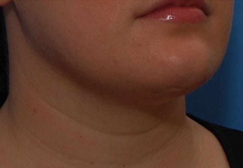 Kybella Before & After Gallery - Patient 690409 - Image 3