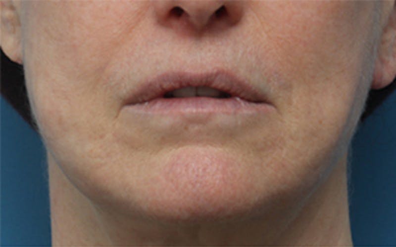 Dermabrasion Before & After Gallery - Patient 150713 - Image 1
