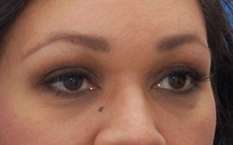 Fillers Before & After Gallery - Patient 341310 - Image 6