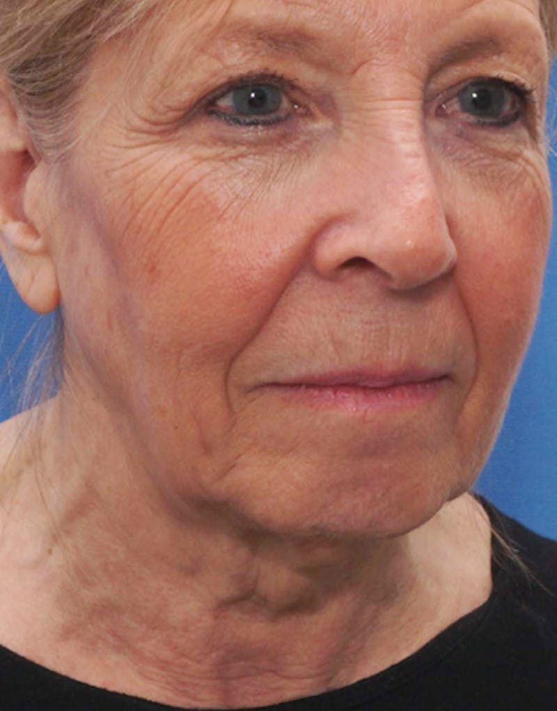 Patient BnFyhuj3Tw6C6yL5F1_59g - Facelift Before & After Photos