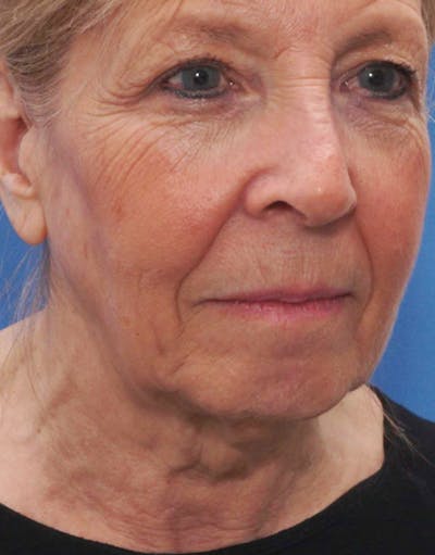 Facelift Before & After Gallery - Patient 112261 - Image 1