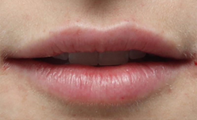 Lip Fillers Before & After Gallery - Patient 156246 - Image 4