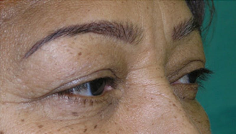 Eyelid Surgery Before & After Gallery - Patient 424184 - Image 3