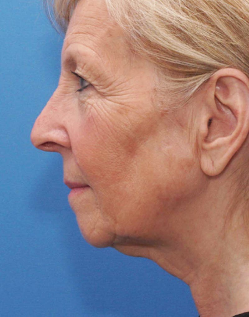 Jawline Contouring Before & After Gallery - Patient 101672 - Image 7