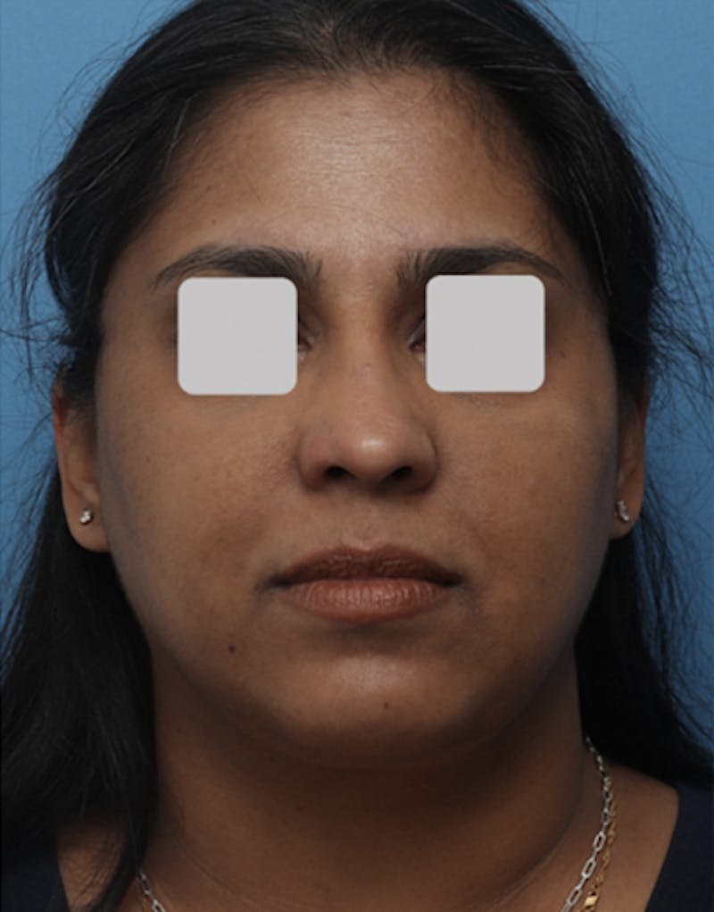 FaceTite Before & After Gallery - Patient 149793 - Image 2