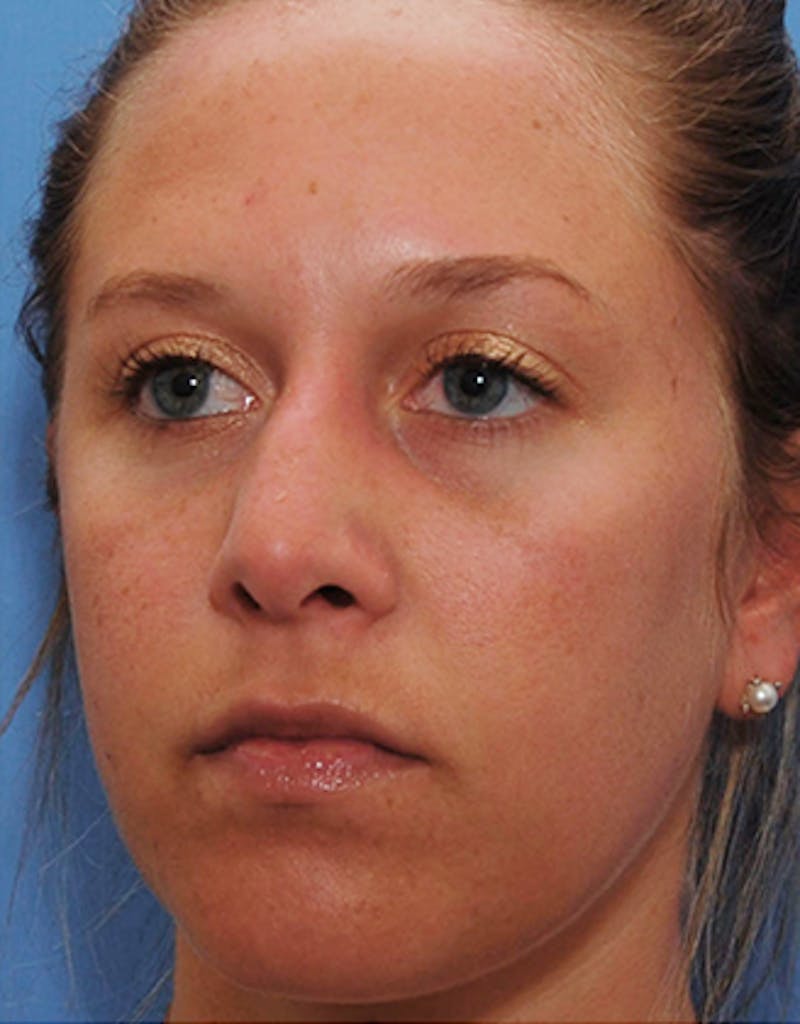 Rhinoplasty Before & After Gallery - Patient 388796 - Image 3