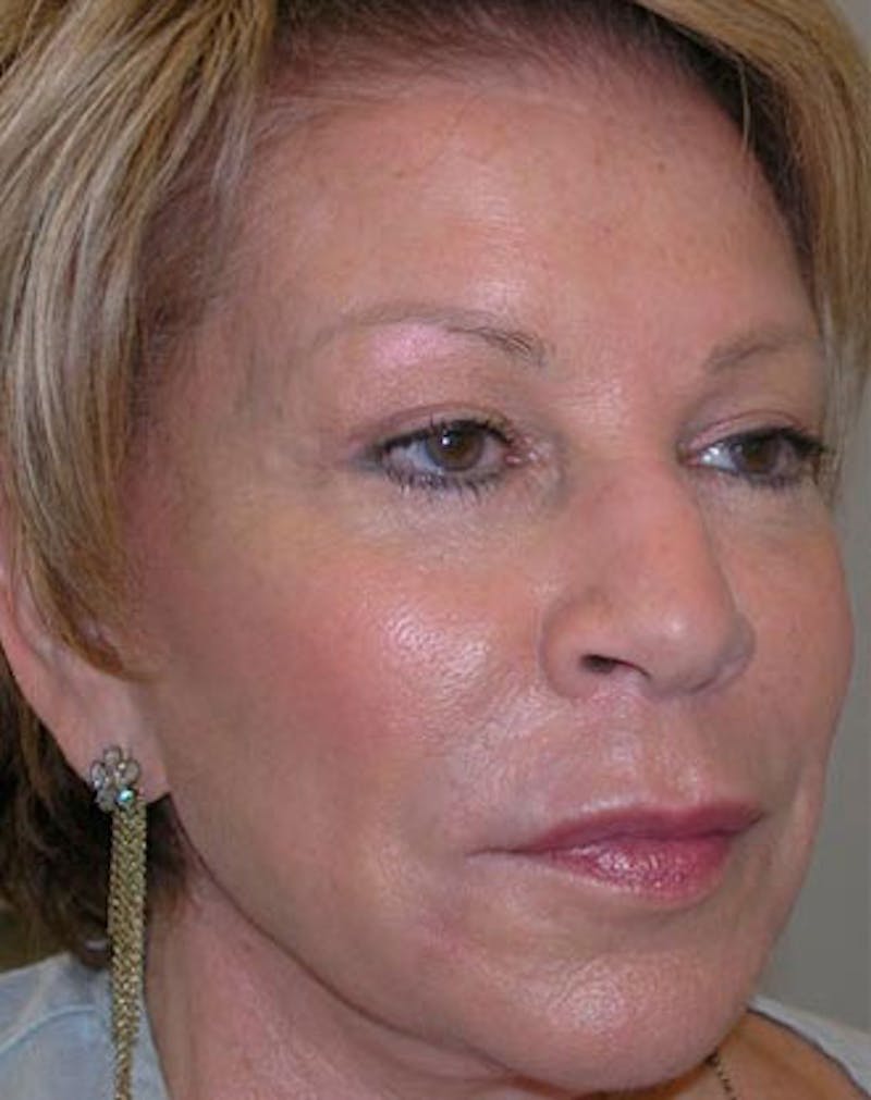 BOTOX Before & After Gallery - Patient 239068 - Image 4