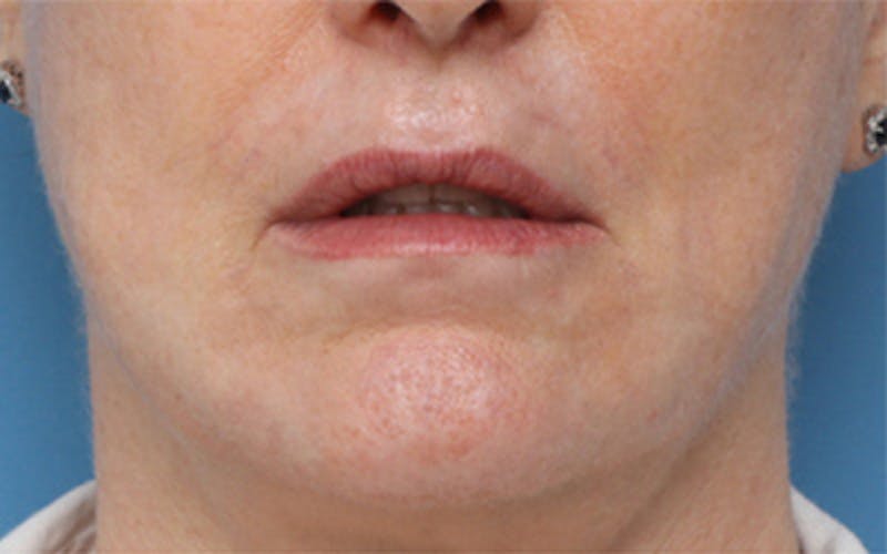 Dermabrasion Before & After Gallery - Patient 150713 - Image 2