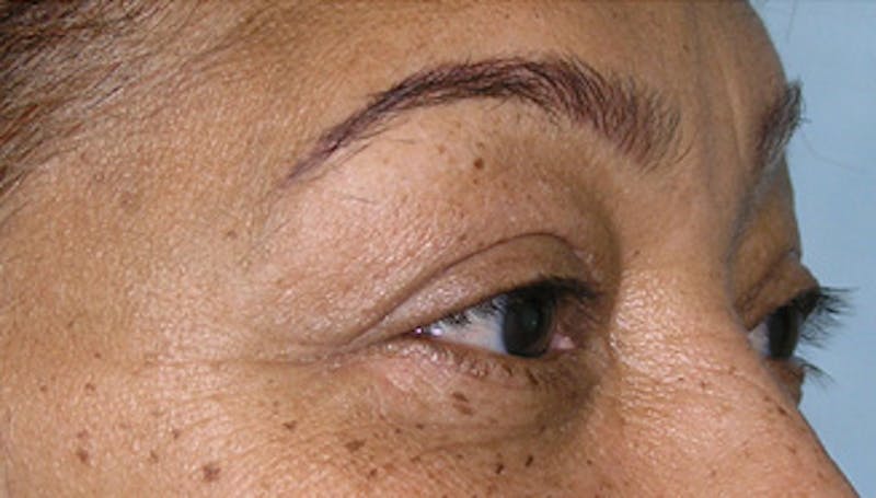 Eyelid Surgery Before & After Gallery - Patient 424184 - Image 4