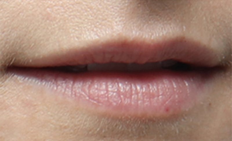 Lip Fillers Before & After Gallery - Patient 156246 - Image 5