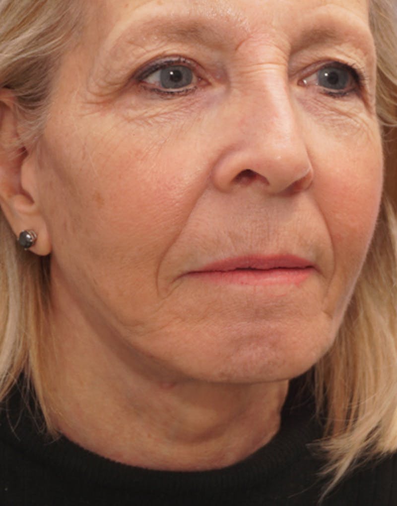 Facelift Before & After Gallery - Patient 112261 - Image 6