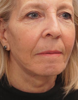 Facelift Before & After Gallery - Patient 112261 - Image 2