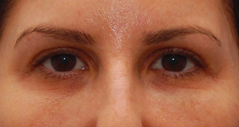 Fillers Before & After Gallery - Patient 987597 - Image 1