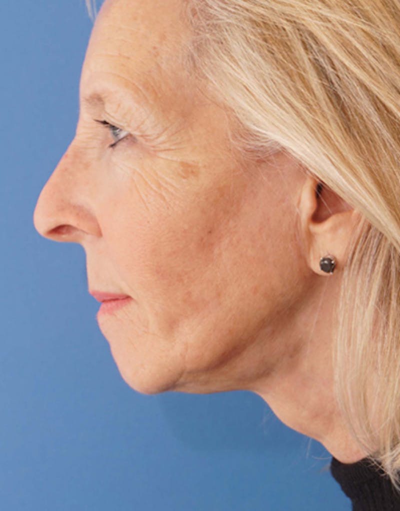 Jawline Contouring Before & After Gallery - Patient 101672 - Image 8