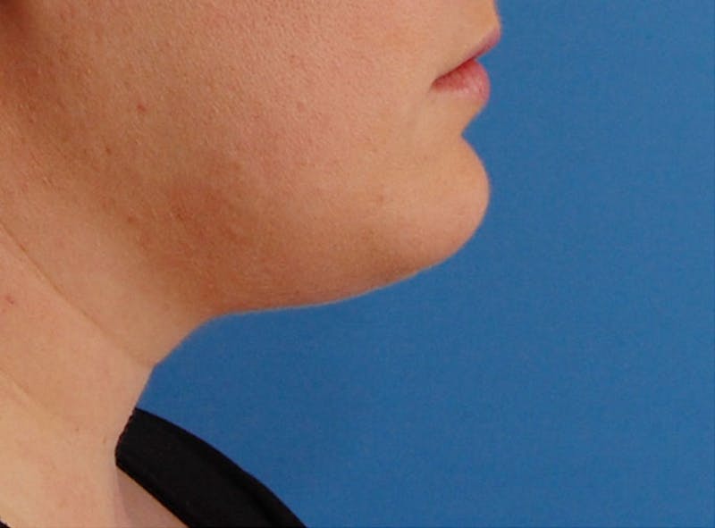 Kybella Before & After Gallery - Patient 690409 - Image 5