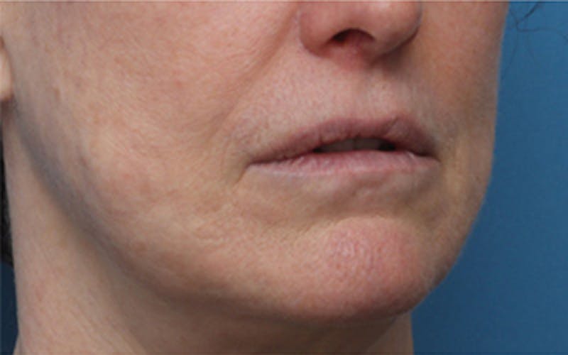 Dermabrasion Before & After Gallery - Patient 150713 - Image 3