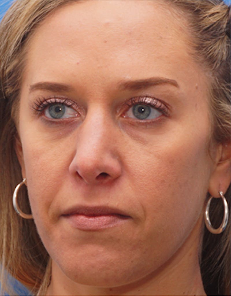 Rhinoplasty  Before & After Gallery - Patient 145106 - Image 4