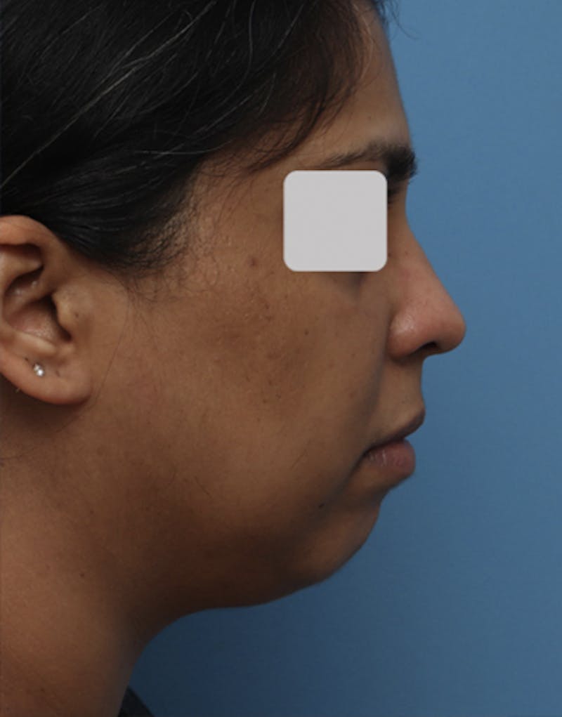 FaceTite Before & After Gallery - Patient 149793 - Image 3