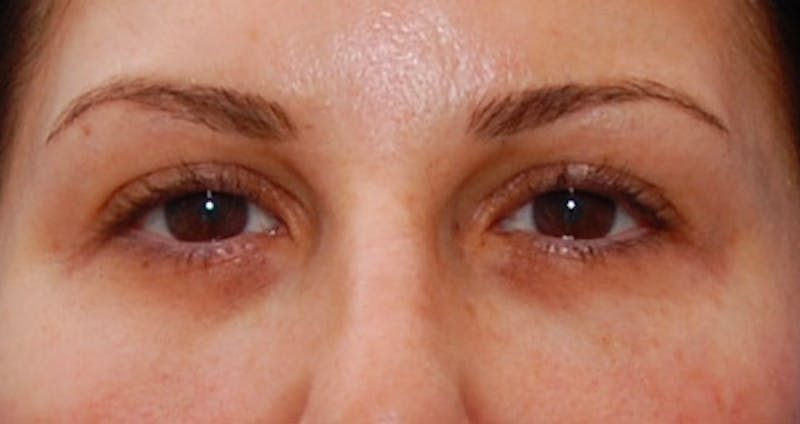Fillers Before & After Gallery - Patient 987597 - Image 2