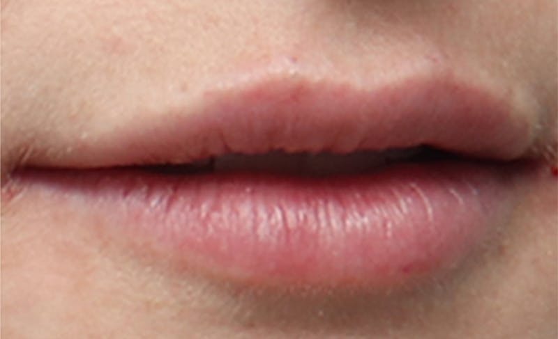 Lip Fillers Before & After Gallery - Patient 156246 - Image 6