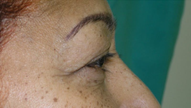 Eyelid Surgery Before & After Gallery - Patient 424184 - Image 5